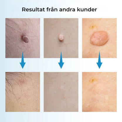 ClearSkin™ Penn – Säker borttagning av hudmärken!